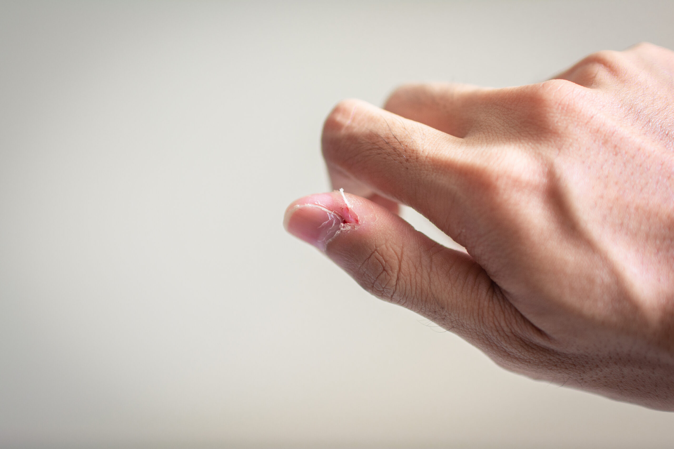 Skin-picking as self-soothing: is emotion regulation the missing piece?