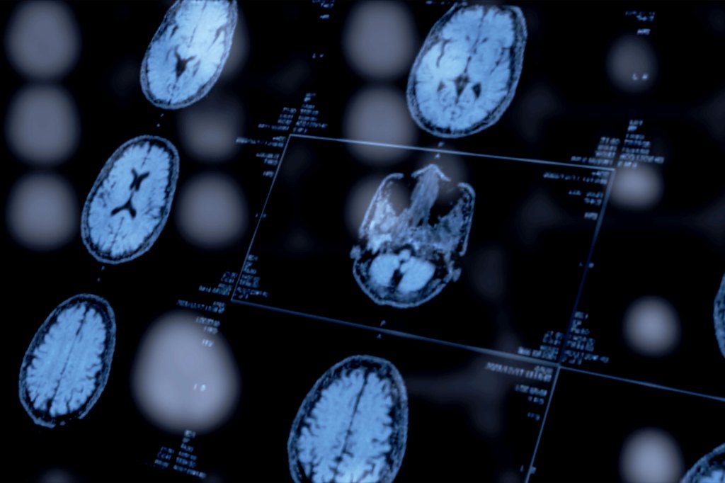 Psiquiatras podrían adoptar biomarcadores en el diagnóstico de la salud mental