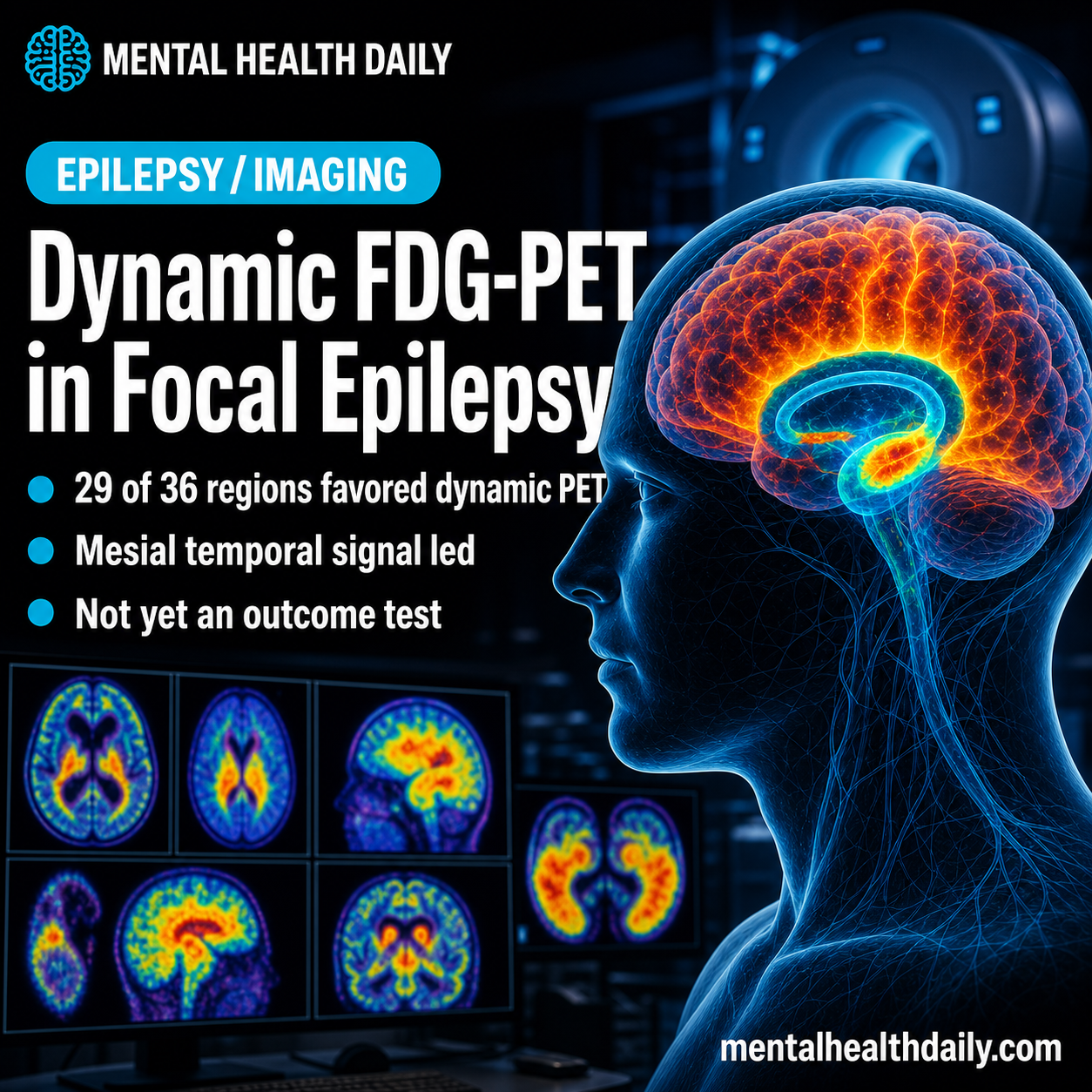 dynamic-fdg-pet-signal-quality-beats-static-pet-in-focal-epilepsy